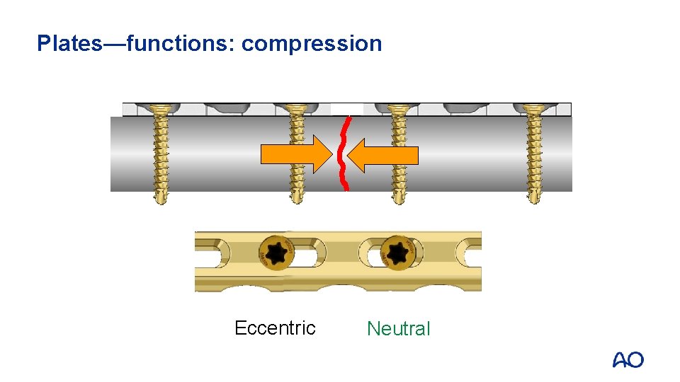Plates—functions: compression Eccentric Neutral 