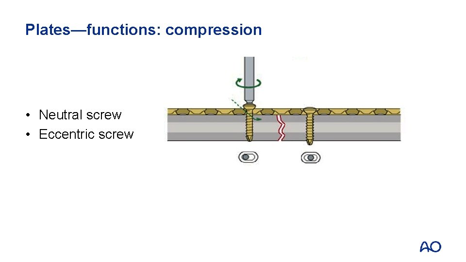 Plates—functions: compression • Neutral screw • Eccentric screw 