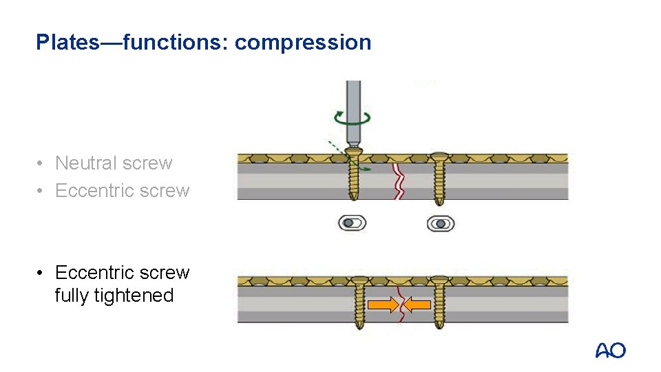 Plates—functions: compression • Neutral screw • Eccentric screw fully tightened 