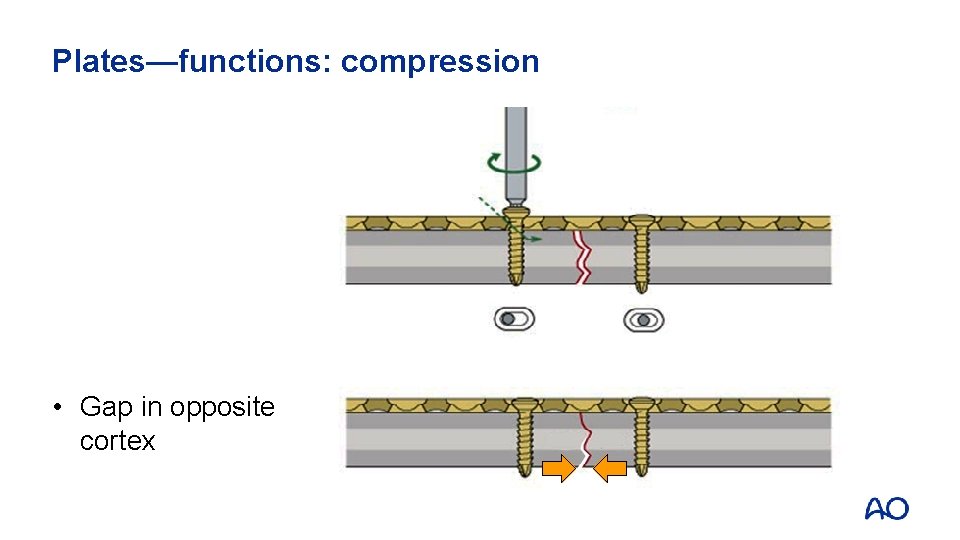 Plates—functions: compression • Gap in opposite cortex 