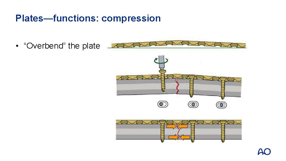 Plates—functions: compression • “Overbend” the plate 