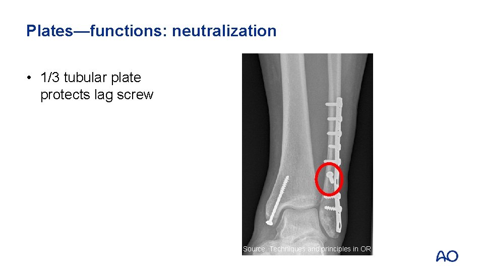 Plates—functions: neutralization • 1/3 tubular plate protects lag screw Source: Techniques and principles in