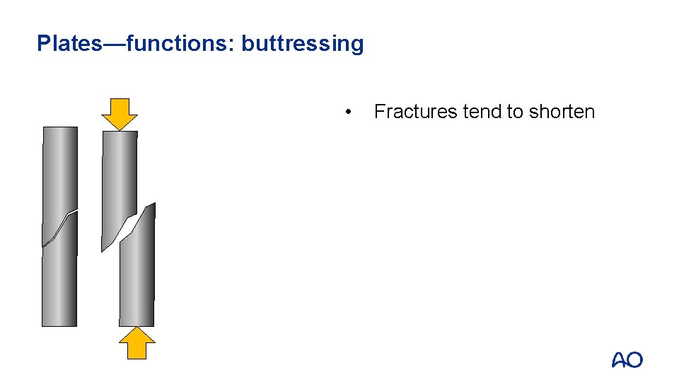 Plates—functions: buttressing • Fractures tend to shorten 