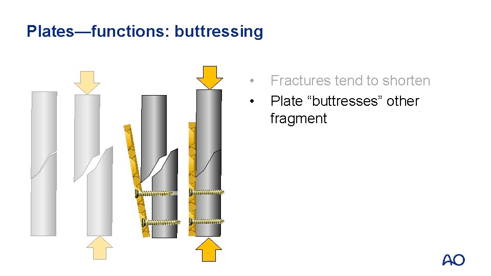 Plates—functions: buttressing • • Fractures tend to shorten Plate “buttresses” other fragment 