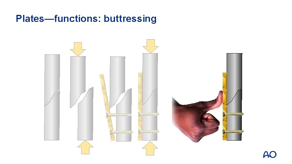 Plates—functions: buttressing 