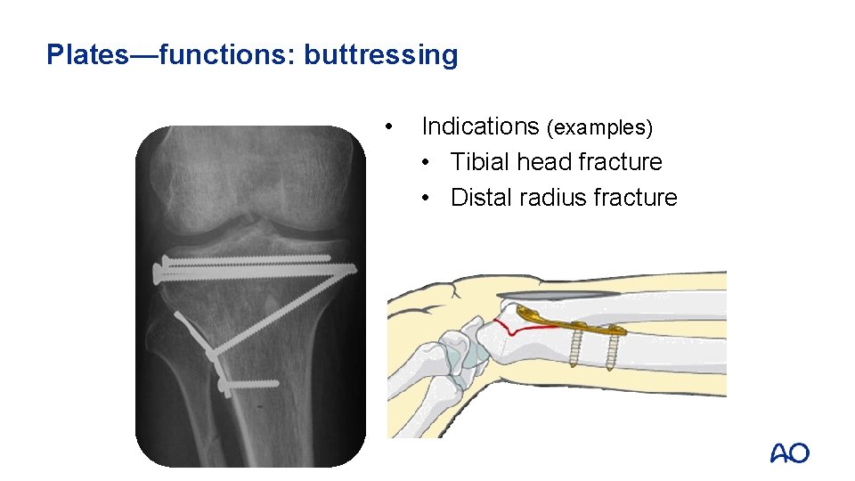 Plates—functions: buttressing • Indications (examples) • Tibial head fracture • Distal radius fracture 