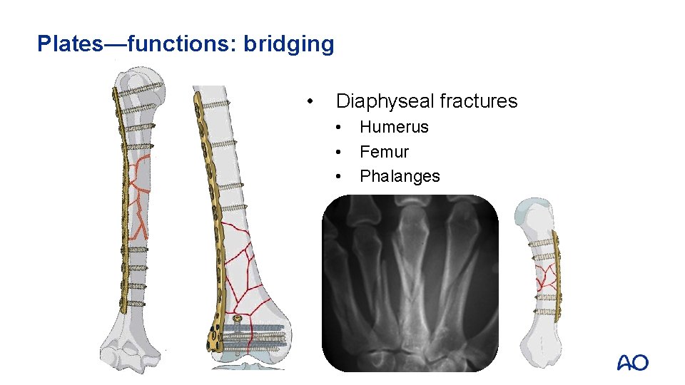 Plates—functions: bridging • Diaphyseal fractures • • • Humerus Femur Phalanges 