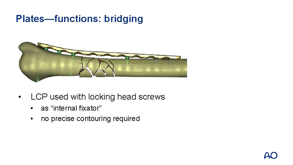 Plates—functions: bridging • LCP used with locking head screws • • as “internal fixator”