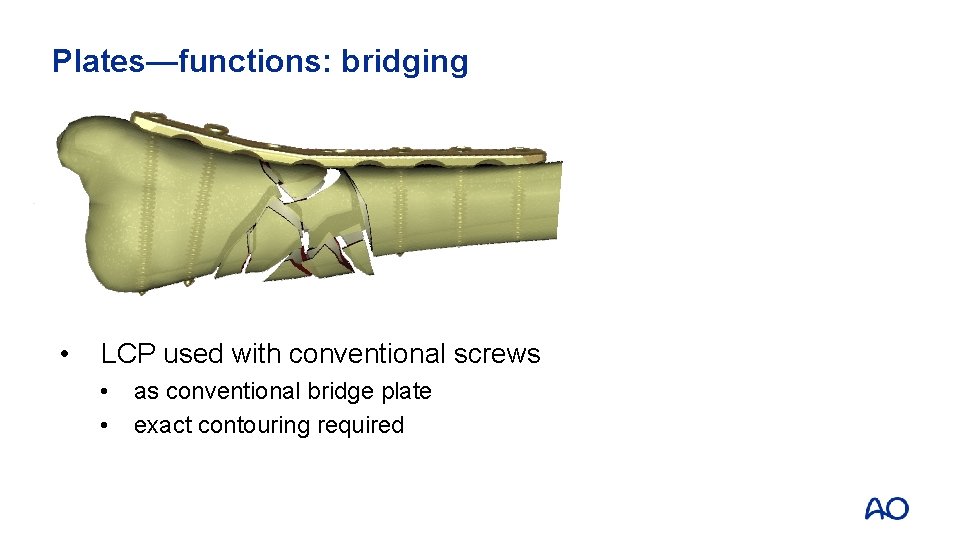 Plates—functions: bridging • LCP used with conventional screws • • as conventional bridge plate