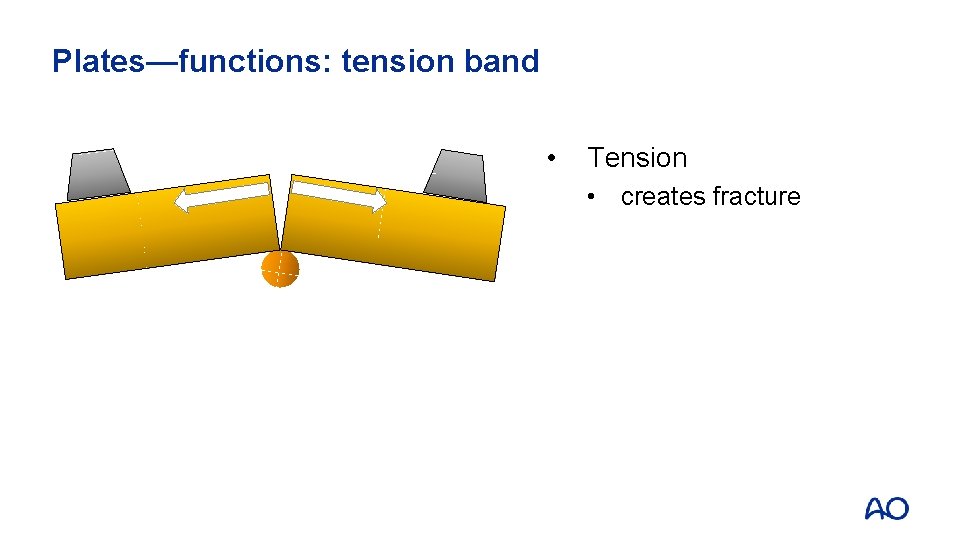 Plates—functions: tension band • Tension • creates fracture 
