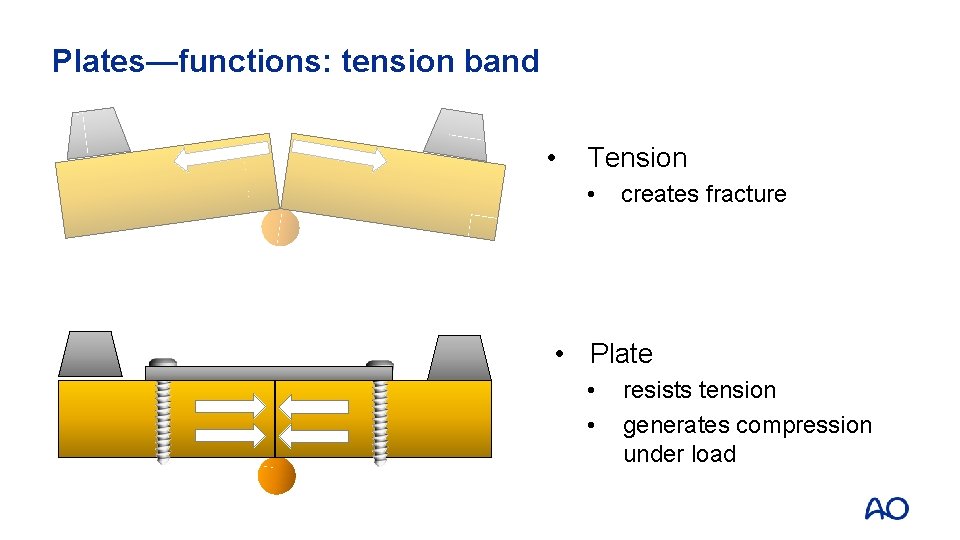 Plates—functions: tension band • Tension • creates fracture • Plate • • resists tension