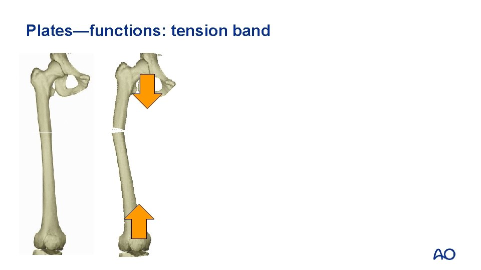 Plates—functions: tension band 