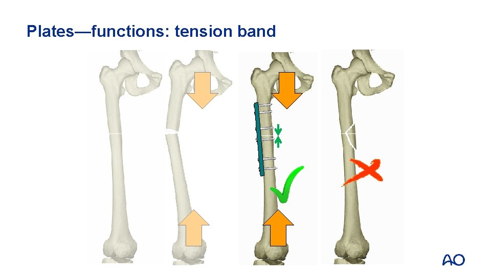 Plates—functions: tension band 