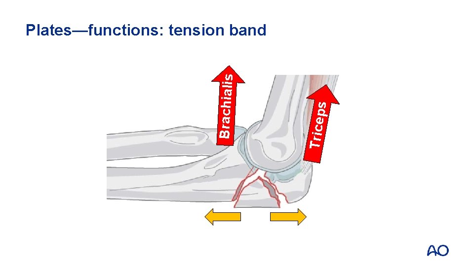 Triceps Brachialis Plates—functions: tension band 