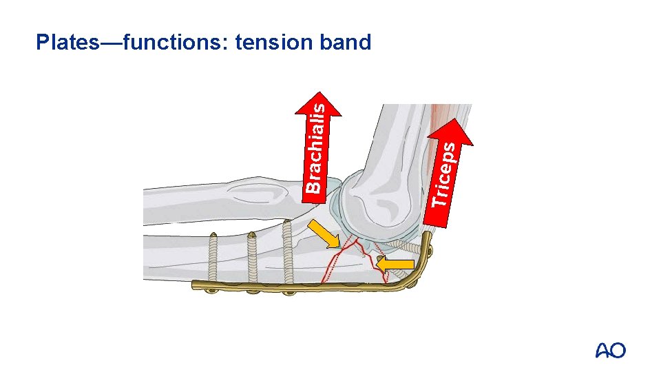 Triceps Brachialis Plates—functions: tension band 