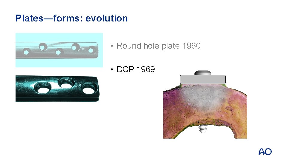 Plates—forms: evolution • Round hole plate 1960 • DCP 1969 