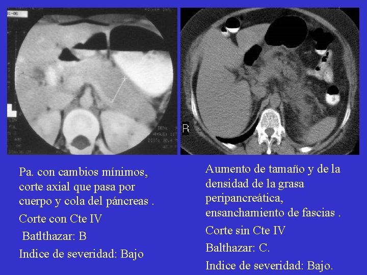 Pa. con cambios mínimos, corte axial que pasa por cuerpo y cola del páncreas. Pa. con cambios mínimos, corte axial que pasa por cuerpo y cola del páncreas.