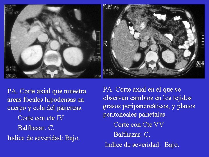 PA. Corte axial que muestra áreas focales hipodensas en cuerpo y cola del páncreas. PA. Corte axial que muestra áreas focales hipodensas en cuerpo y cola del páncreas.