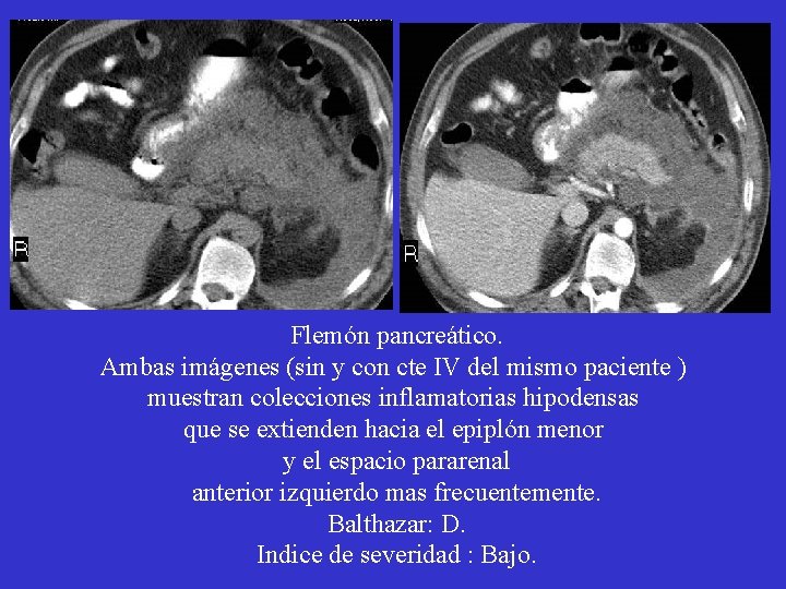Flemón pancreático. Ambas imágenes (sin y con cte IV del mismo paciente ) muestran Flemón pancreático. Ambas imágenes (sin y con cte IV del mismo paciente ) muestran