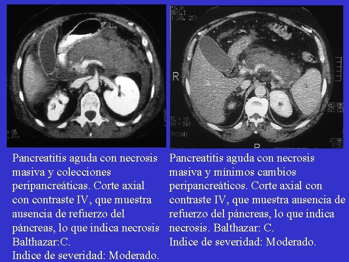 Pancreatitis aguda con necrosis masiva y colecciones peripancreáticas. Corte axial contraste IV, que muestra Pancreatitis aguda con necrosis masiva y colecciones peripancreáticas. Corte axial contraste IV, que muestra