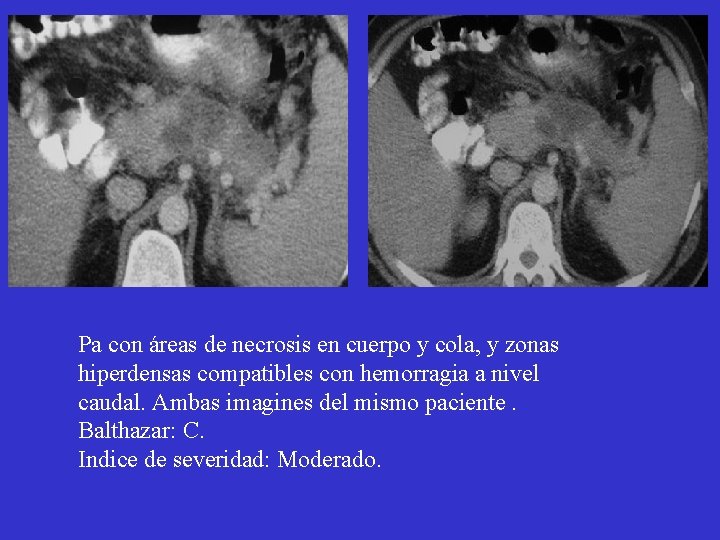 Pa con áreas de necrosis en cuerpo y cola, y zonas hiperdensas compatibles con Pa con áreas de necrosis en cuerpo y cola, y zonas hiperdensas compatibles con