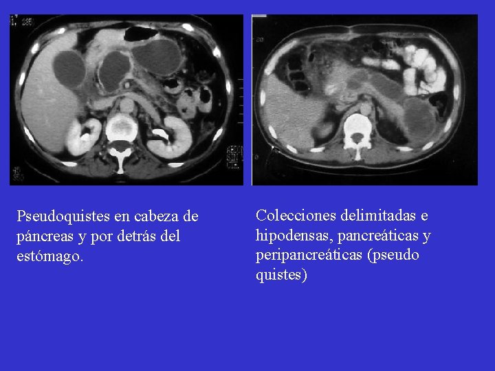 Pseudoquistes en cabeza de páncreas y por detrás del estómago. Colecciones delimitadas e hipodensas, Pseudoquistes en cabeza de páncreas y por detrás del estómago. Colecciones delimitadas e hipodensas,