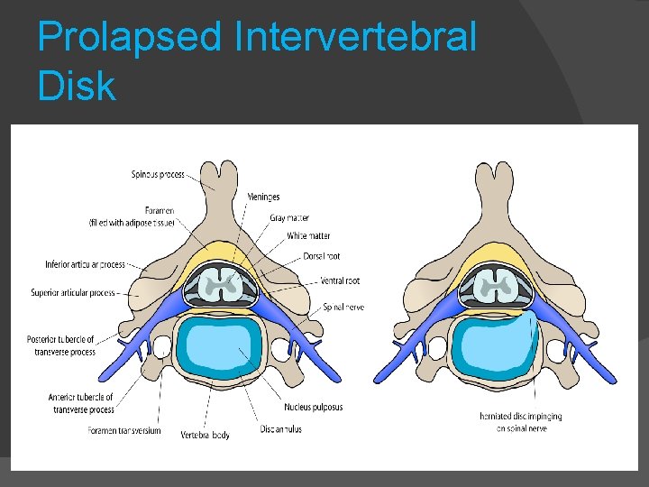 Prolapsed Intervertebral Disk 