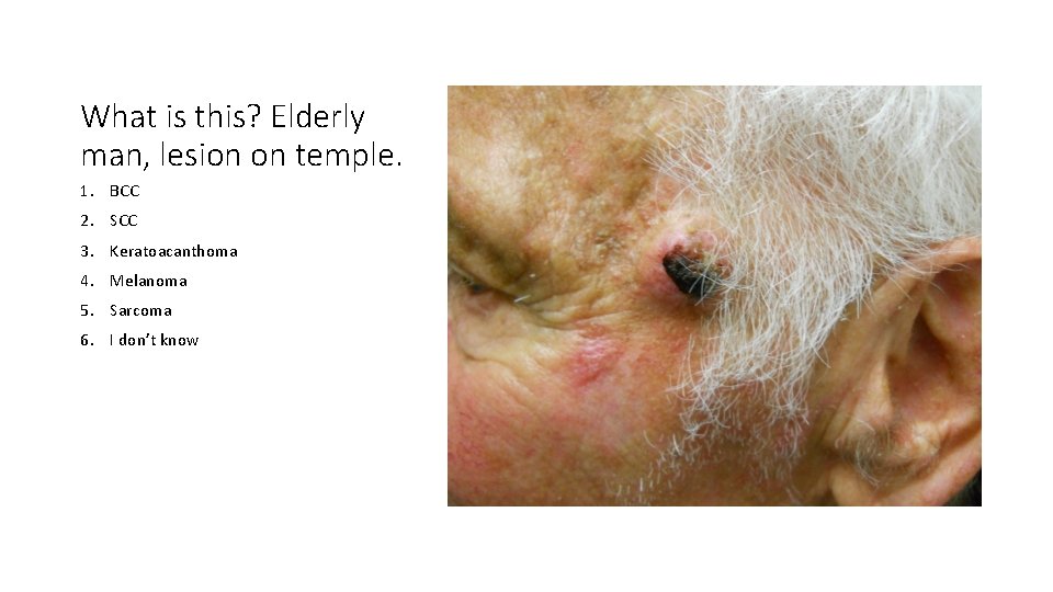 What is this? Elderly man, lesion on temple. 1. BCC 2. SCC 3. Keratoacanthoma