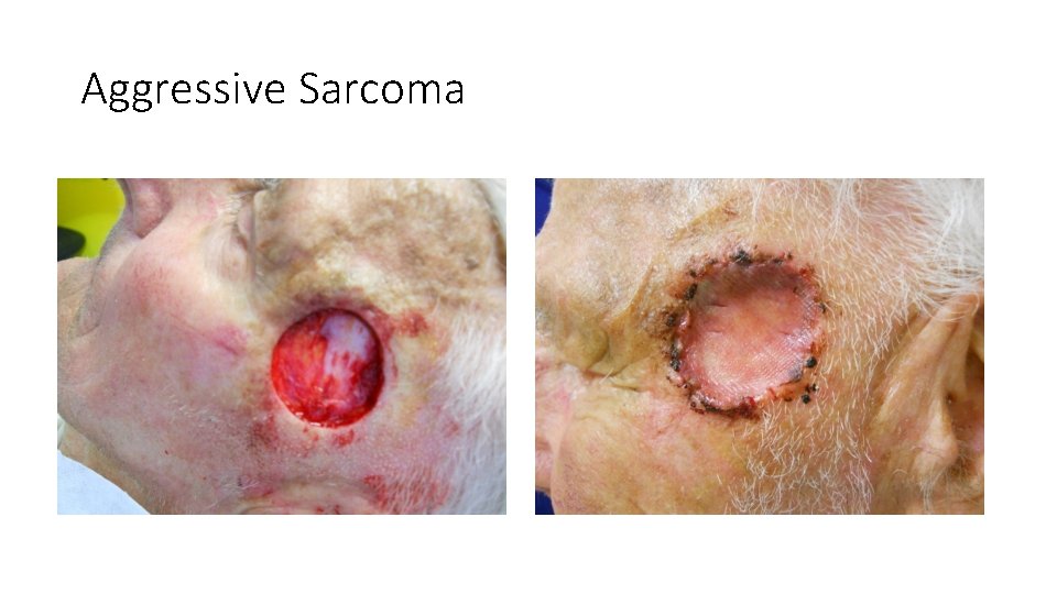 Aggressive Sarcoma 