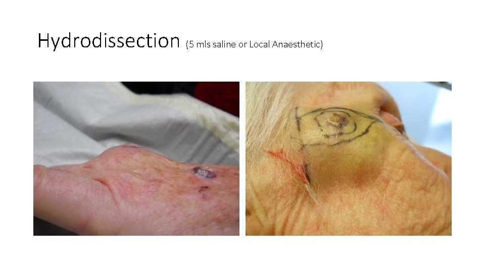 Hydrodissection (5 mls saline or Local Anaesthetic) 