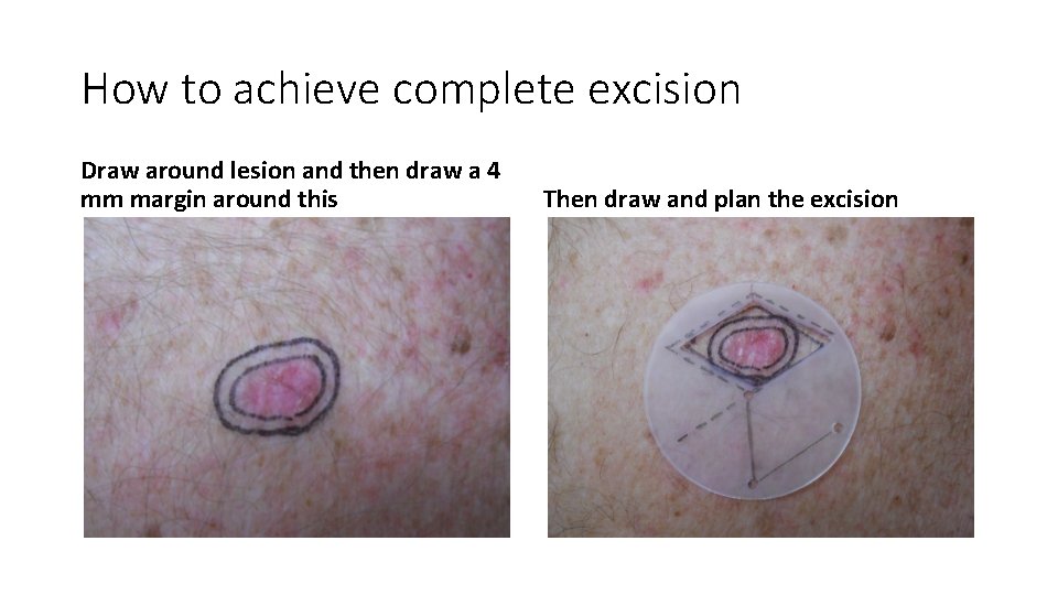 How to achieve complete excision Draw around lesion and then draw a 4 mm