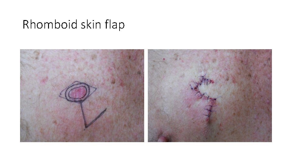 Rhomboid skin flap 