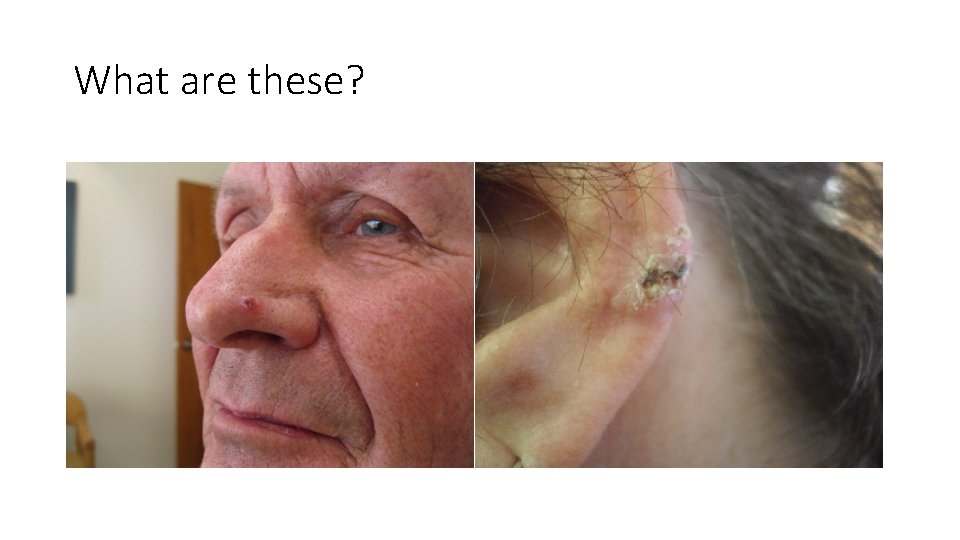 What are these? • What is this lesion on the side of the nose?