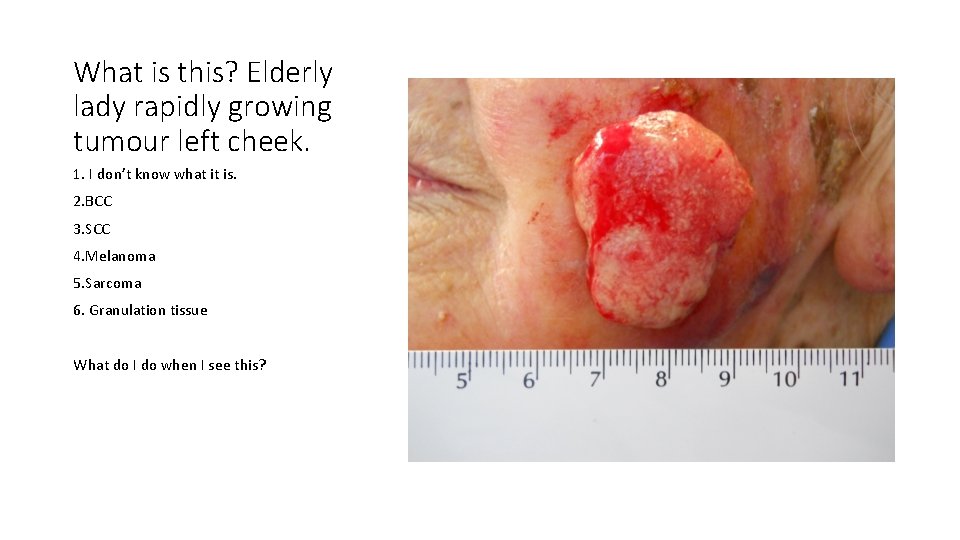 What is this? Elderly lady rapidly growing tumour left cheek. 1. I don’t know