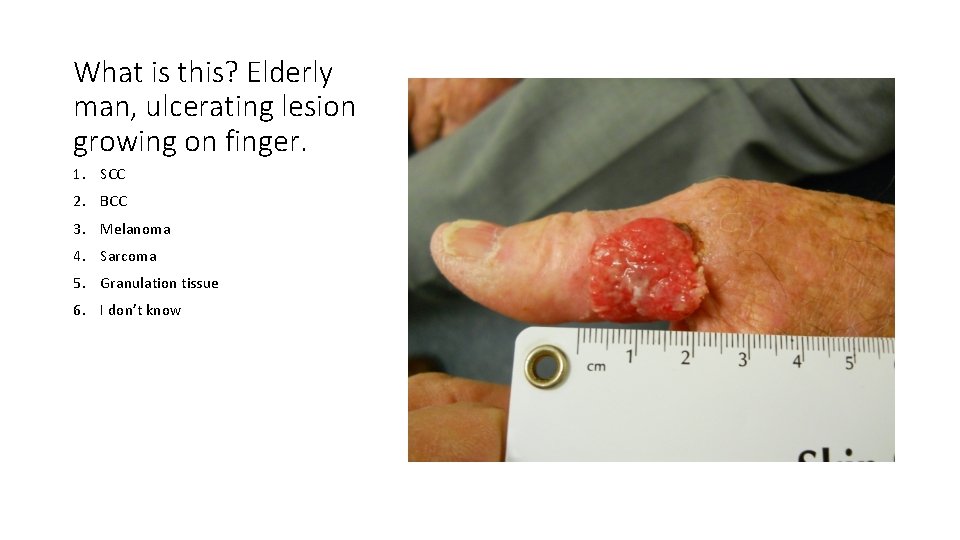What is this? Elderly man, ulcerating lesion growing on finger. 1. SCC 2. BCC