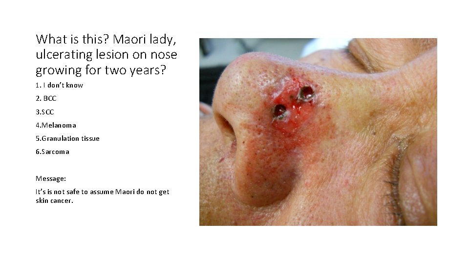 What is this? Maori lady, ulcerating lesion on nose growing for two years? 1.