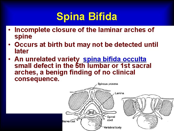 Spina Bifida • Incomplete closure of the laminar arches of the spine • Occurs