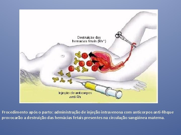 Procedimento após o parto: administração de injeção intravenosa com anticorpos anti-Rhque provocarão a destruição