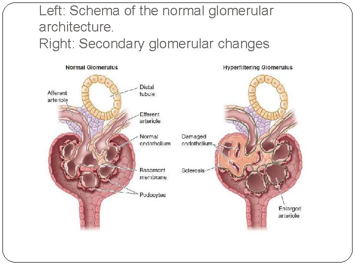 Left: Schema of the normal glomerular architecture. Right: Secondary glomerular changes 