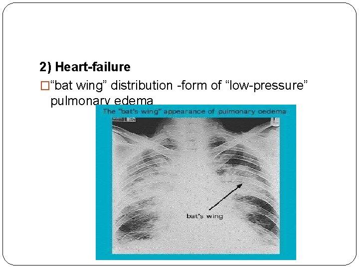 2) Heart-failure �“bat wing” distribution -form of “low-pressure” pulmonary edema 