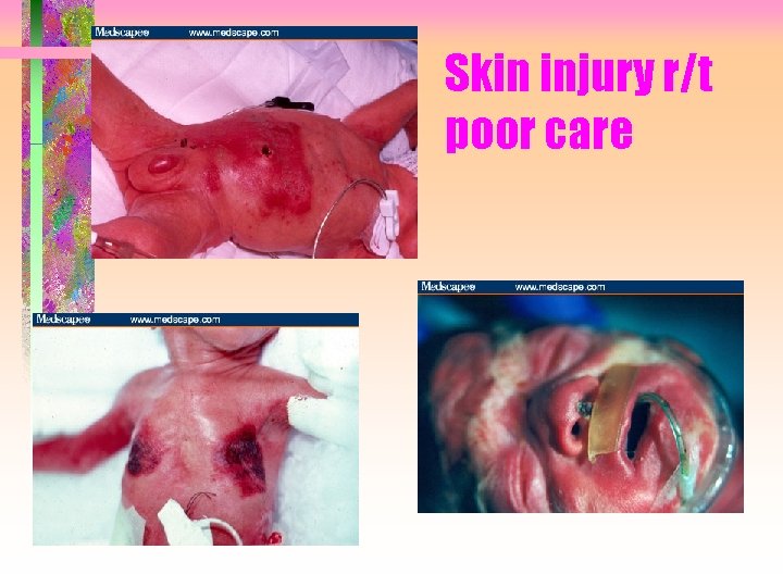 Skin injury r/t poor care 