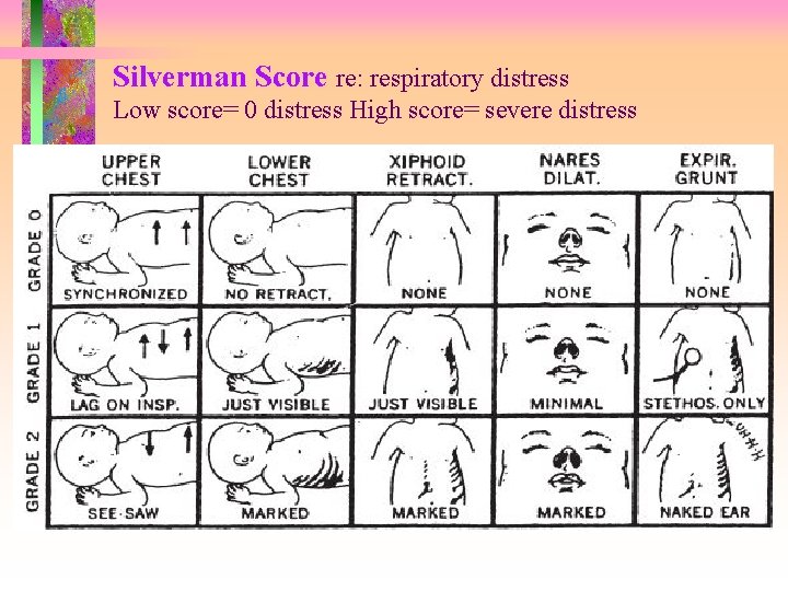 Silverman Score re: respiratory distress Low score= 0 distress High score= severe distress 