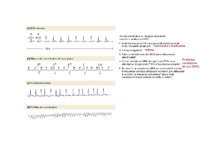 Tachicardia o bradicardia Aritmia Problema conduzione AV (no QRS) Tachicardia o bradicardia Aritmia Problema conduzione AV (no QRS)