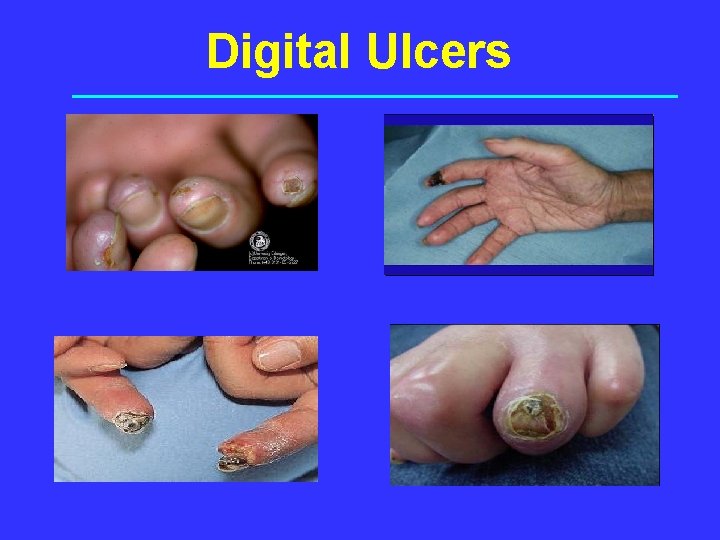 Digital Ulcers 