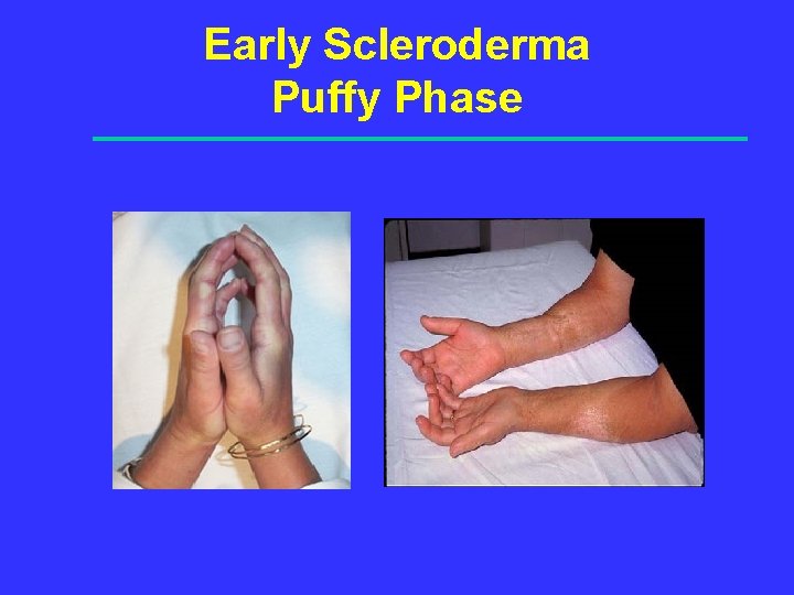 Early Scleroderma Puffy Phase 