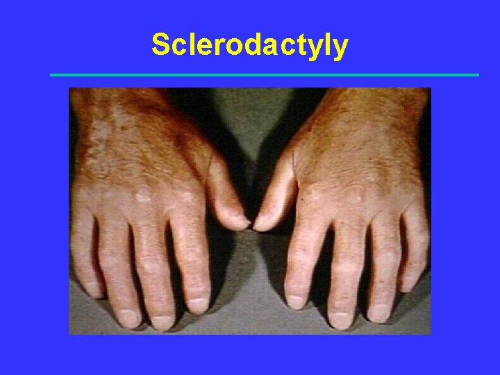 Sclerodactyly 