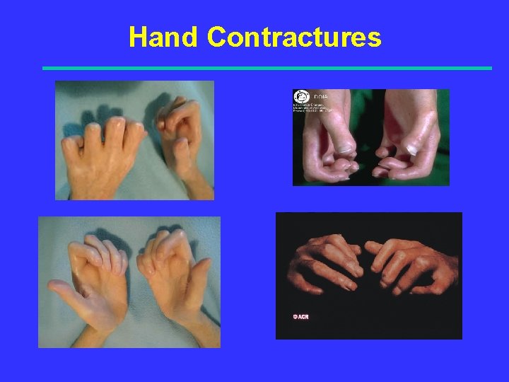 Hand Contractures 