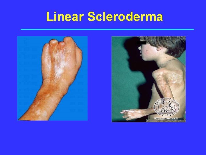 Linear Scleroderma Severe contractures, growth disturbances, atrophy 