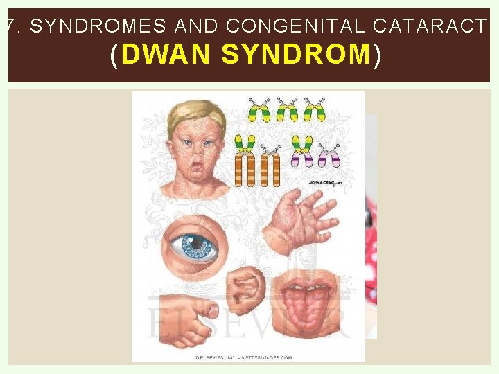 7. SYNDROMES AND CONGENITAL CATARACT ( DWAN SYNDROM ) 