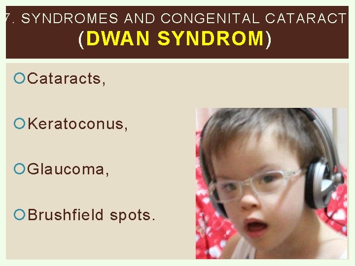 7. SYNDROMES AND CONGENITAL CATARACT ( DWAN SYNDROM ) Cataracts, Keratoconus, Glaucoma, Brushfield spots.